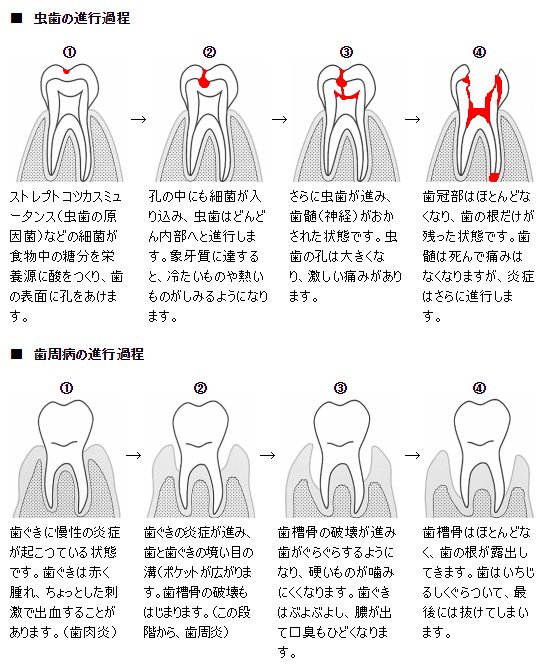 虫歯と歯周病の進行過程