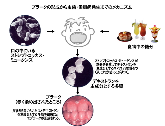 プラークメカニズム