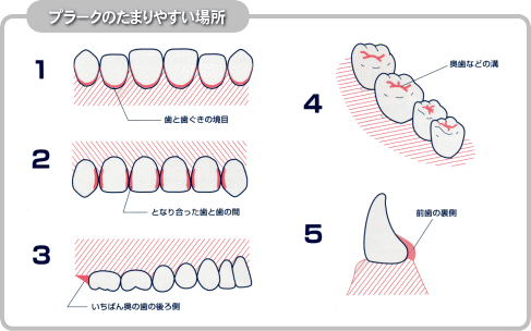 プラークのたまりやすい場所