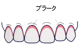 歯と歯ぐきの境目