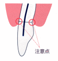 さし歯や詰め物のある歯
