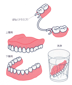 部分入れ歯（局部義歯）